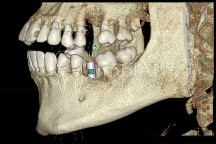 Tomografia computadorizada 3D para planejamento de implantes